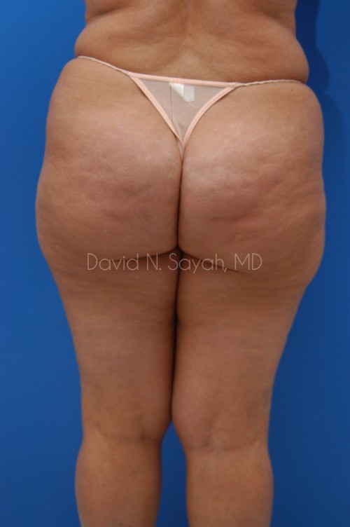 Liposuction Before and After | Sayah Institute