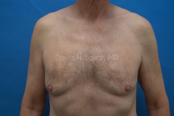 Liposuction Before and After | Sayah Institute