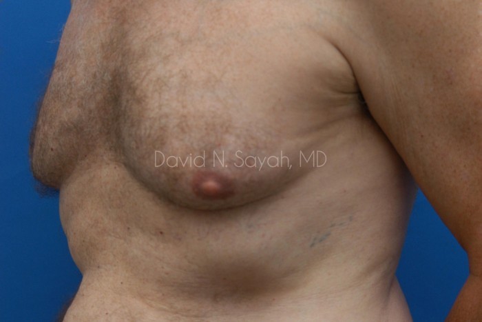 Liposuction Before and After | Sayah Institute