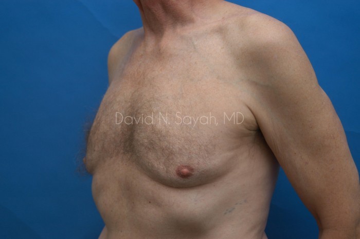 Liposuction Before and After | Sayah Institute