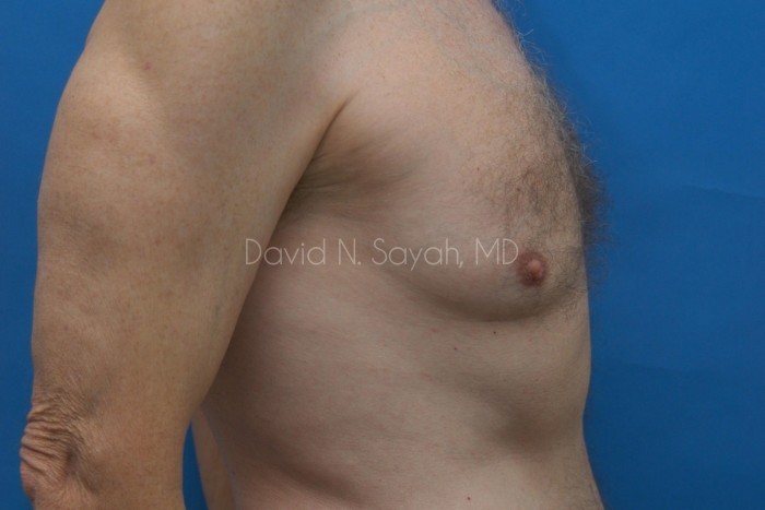 Liposuction Before and After | Sayah Institute