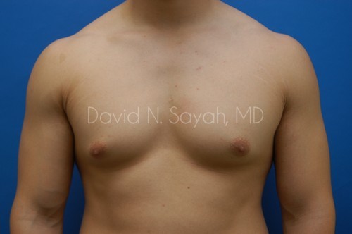 Liposuction Before and After | Sayah Institute