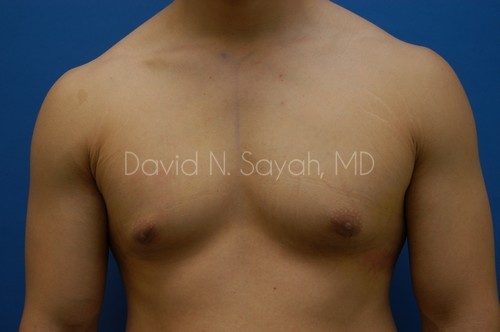 Liposuction Before and After | Sayah Institute