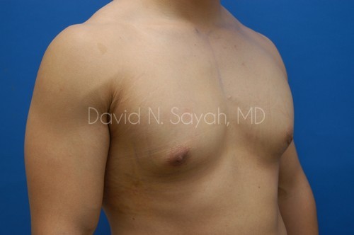 Liposuction Before and After | Sayah Institute