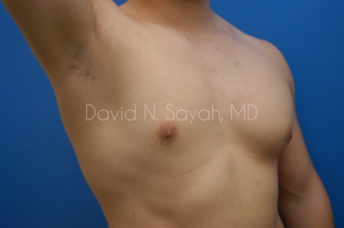 Liposuction Before and After | Sayah Institute