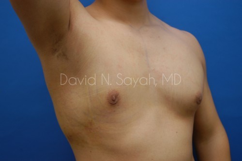 Liposuction Before and After | Sayah Institute