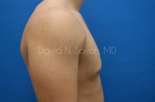 Liposuction Before and After | Sayah Institute