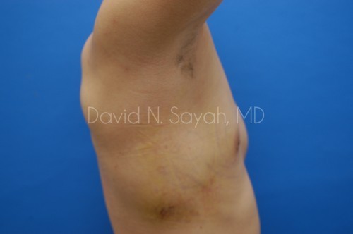 Liposuction Before and After | Sayah Institute