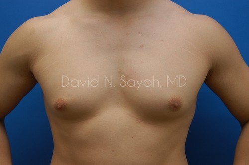 Liposuction Before and After | Sayah Institute