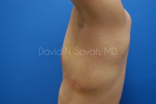Liposuction Before and After | Sayah Institute