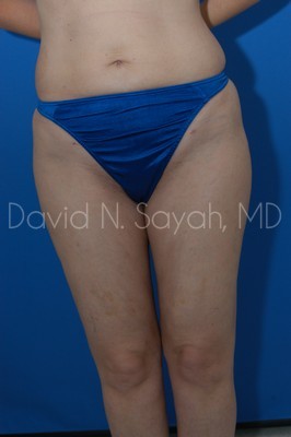 Liposuction Before and After | Sayah Institute