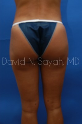 Liposuction Before and After | Sayah Institute