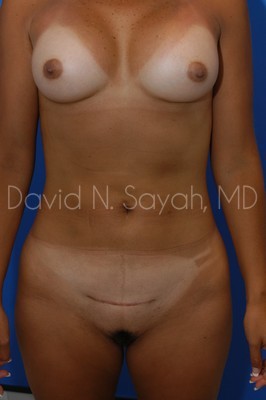 Liposuction Before and After | Sayah Institute