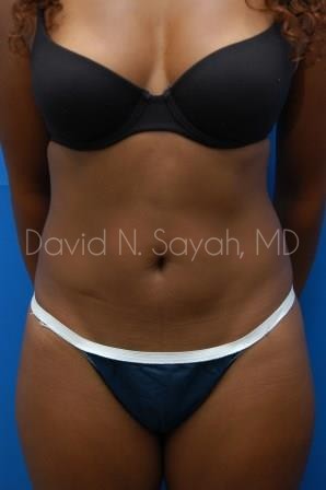 Liposuction Before and After | Sayah Institute