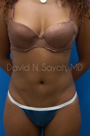 Liposuction Before and After | Sayah Institute