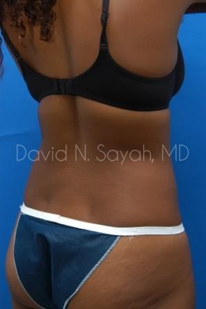 Liposuction Before and After | Sayah Institute