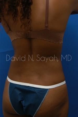 Liposuction Before and After | Sayah Institute