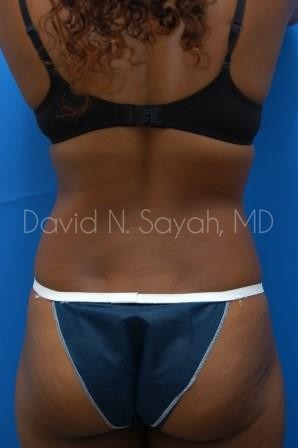 Liposuction Before and After | Sayah Institute