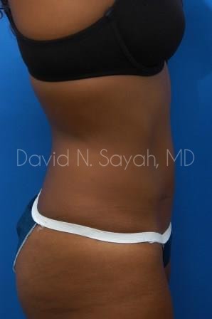 Liposuction Before and After | Sayah Institute