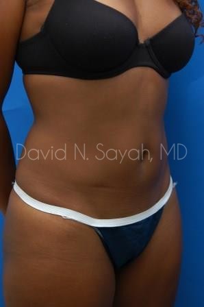 Liposuction Before and After | Sayah Institute