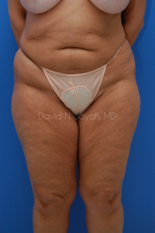 Liposuction Before and After | Sayah Institute