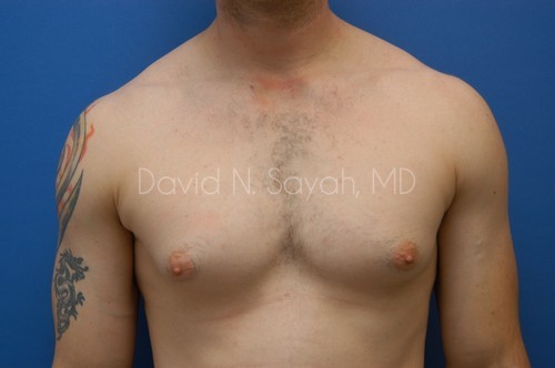 Liposuction Before and After | Sayah Institute