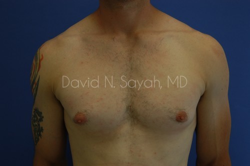 Liposuction Before and After | Sayah Institute