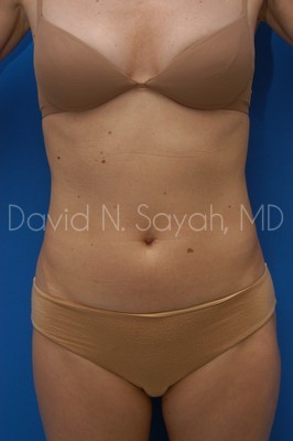 Liposuction Before and After | Sayah Institute