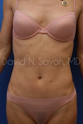 Liposuction Before and After | Sayah Institute