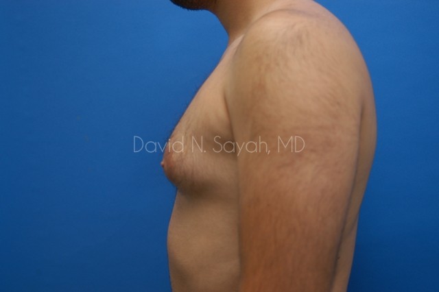 Liposuction Before and After | Sayah Institute