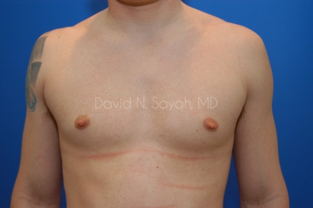 Liposuction Before and After | Sayah Institute