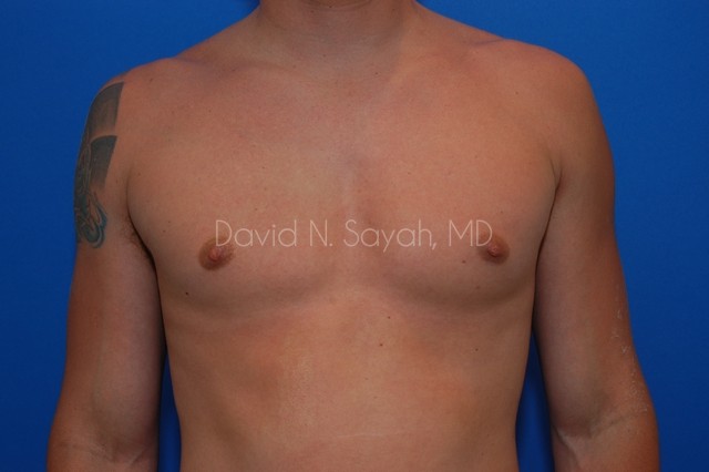 Liposuction Before and After | Sayah Institute