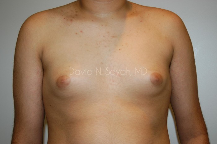 Liposuction Before and After | Sayah Institute