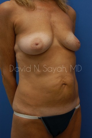 Liposuction Before and After | Sayah Institute