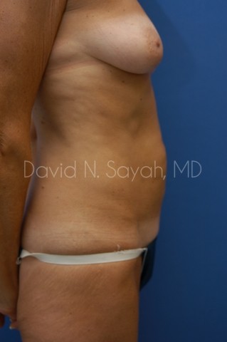 Liposuction Before and After | Sayah Institute