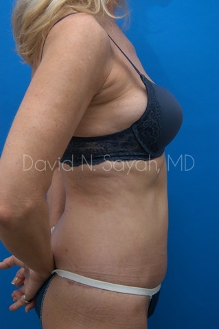 Liposuction Before and After | Sayah Institute