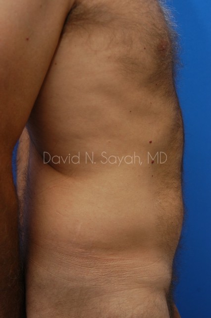 Liposuction Before and After | Sayah Institute