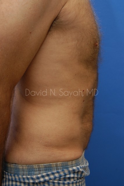 Liposuction Before and After | Sayah Institute