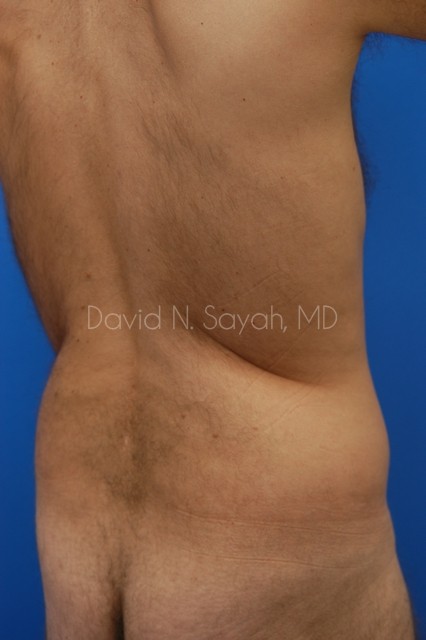 Liposuction Before and After | Sayah Institute