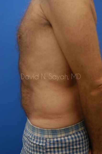 Liposuction Before and After | Sayah Institute