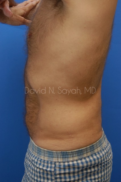 Liposuction Before and After | Sayah Institute