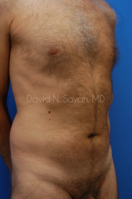 Liposuction Before and After | Sayah Institute