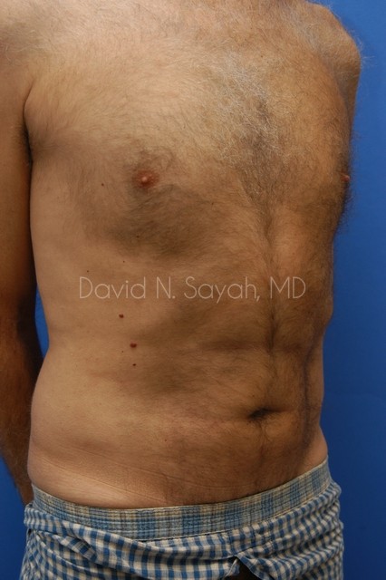 Liposuction Before and After | Sayah Institute