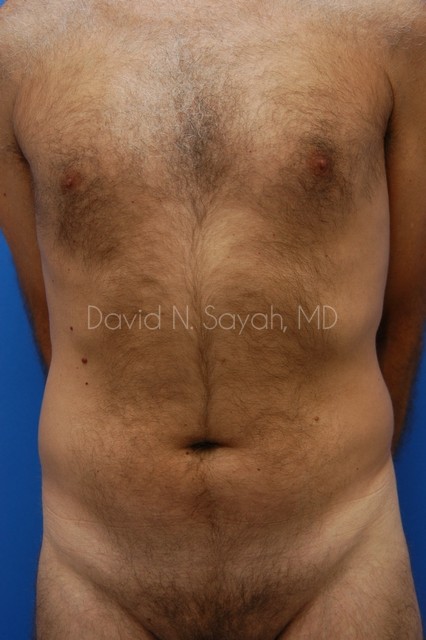 Liposuction Before and After | Sayah Institute