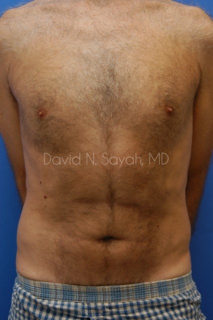 Liposuction Before and After | Sayah Institute