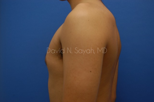 Liposuction Before and After | Sayah Institute