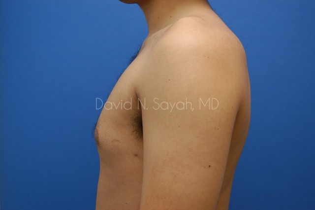 Liposuction Before and After | Sayah Institute