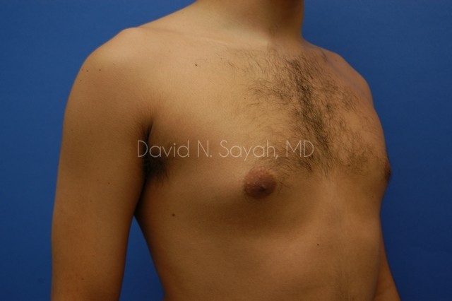 Liposuction Before and After | Sayah Institute