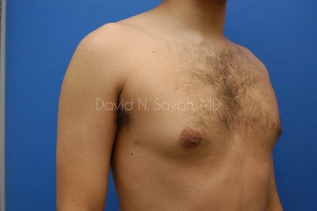 Liposuction Before and After | Sayah Institute