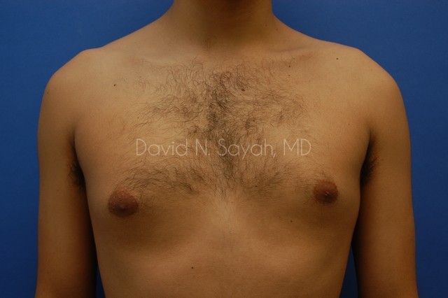 Liposuction Before and After | Sayah Institute